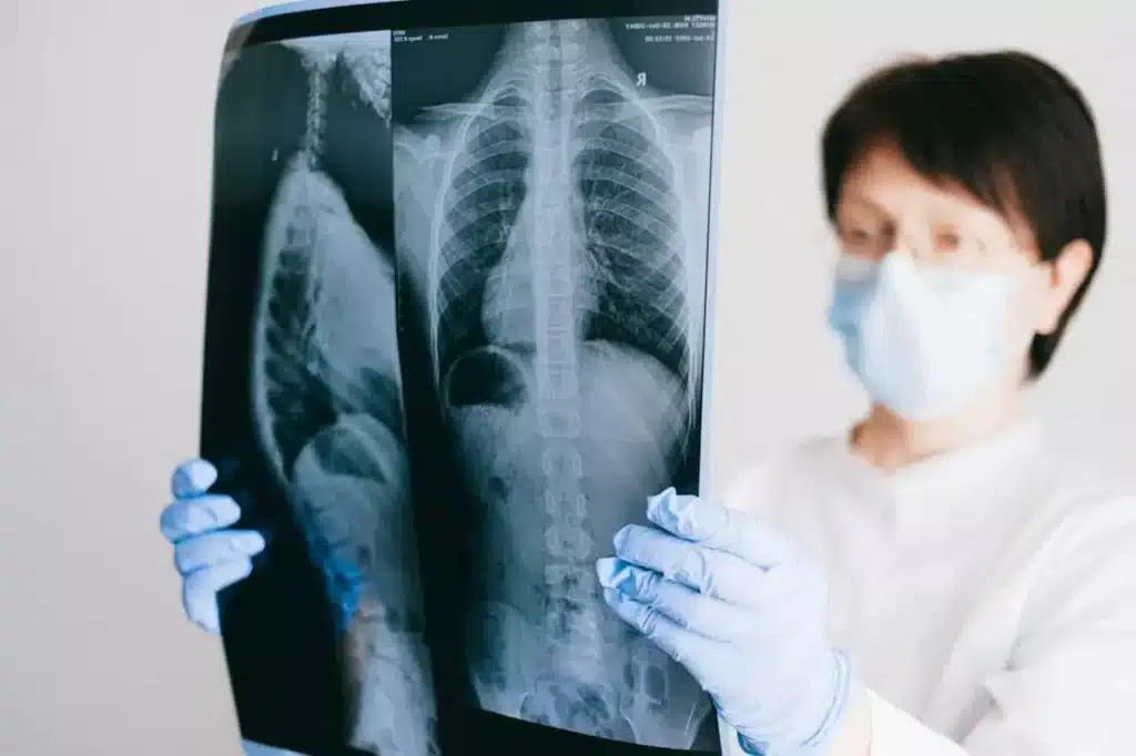 Läkare som håller upp bild på lungröntgen